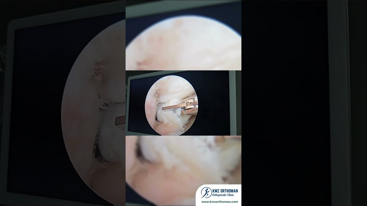 Minimally invasive knee surgery educational video