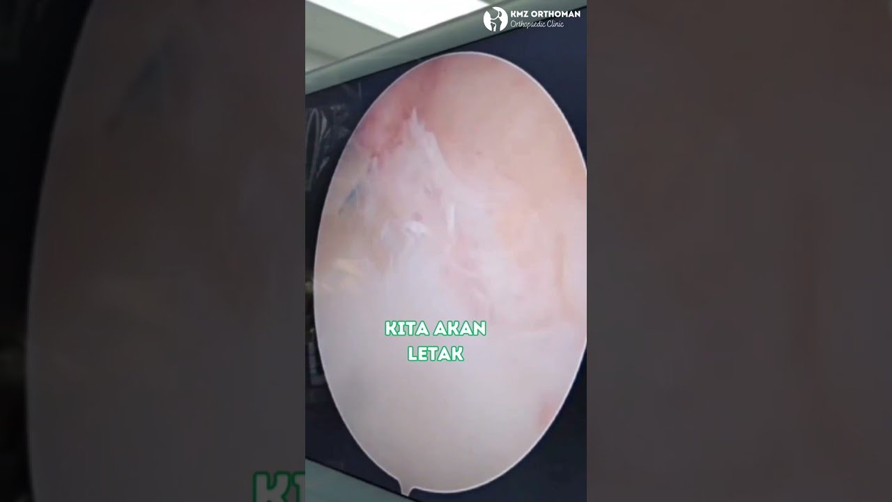 Knee arthroscopy educational video