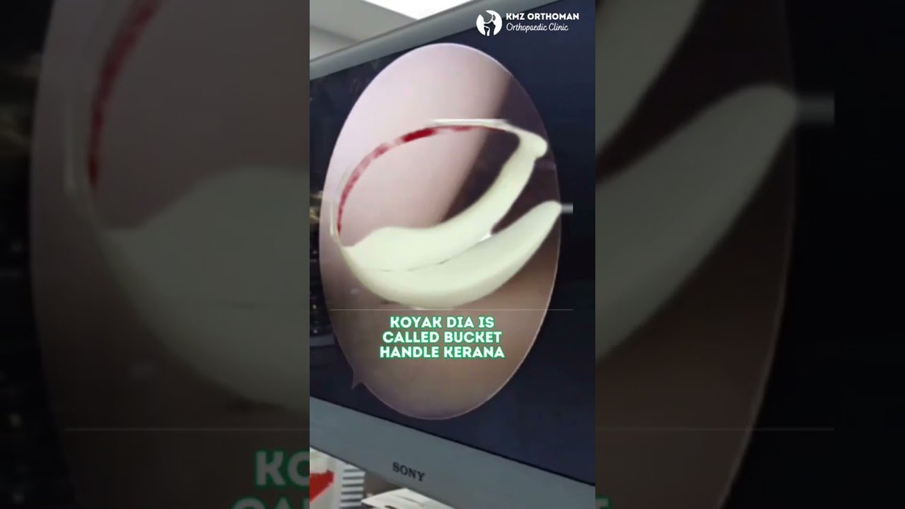 Minimally invasive knee procedure educational video