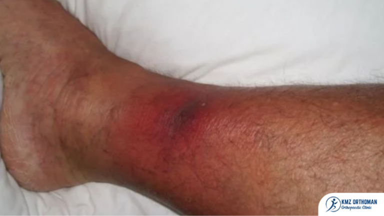 Do You Know About Flesh-Eating Bacteria or Necrotizing Fasciitis?