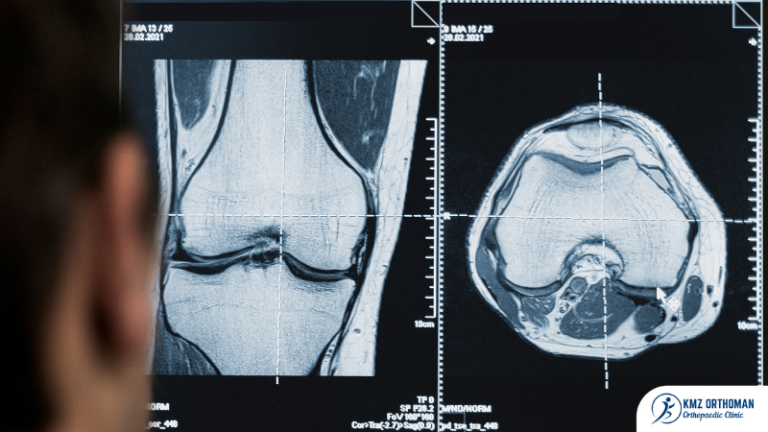 Sports Injury: Consultation Services Available at KMZ Orthoman