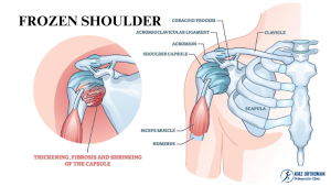 Frozen Shoulder: Symptoms, Diagnosis, and Treatment