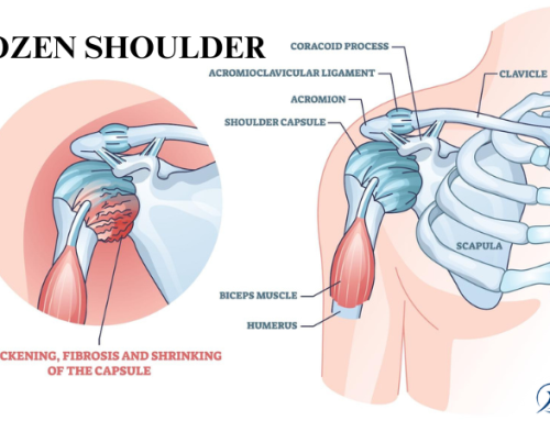 Frozen Shoulder: Symptoms, Diagnosis, and Treatment