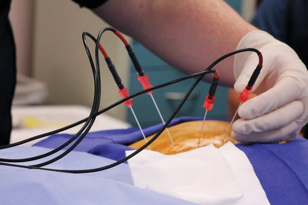 Lumbar radiofrequency ablation procedure for back pain
